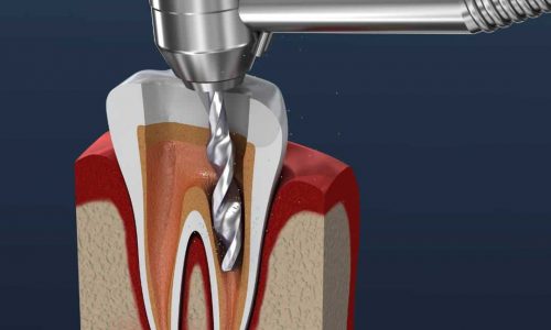 Root-Canal-therapy